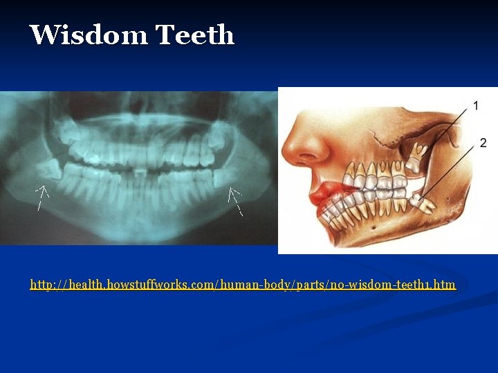 Wisdom Teeth http: //health. howstuffworks. com/human-body/parts/no-wisdom-teeth 1. htm 