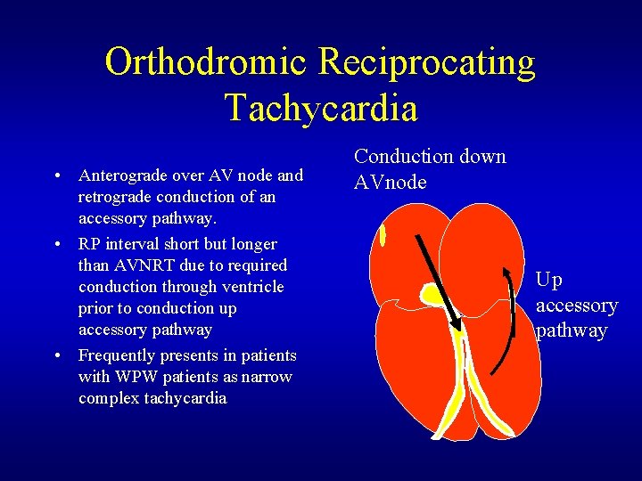Orthodromic Reciprocating Tachycardia • Anterograde over AV node and retrograde conduction of an accessory Orthodromic Reciprocating Tachycardia • Anterograde over AV node and retrograde conduction of an accessory