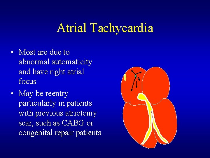 Atrial Tachycardia • Most are due to abnormal automaticity and have right atrial focus Atrial Tachycardia • Most are due to abnormal automaticity and have right atrial focus