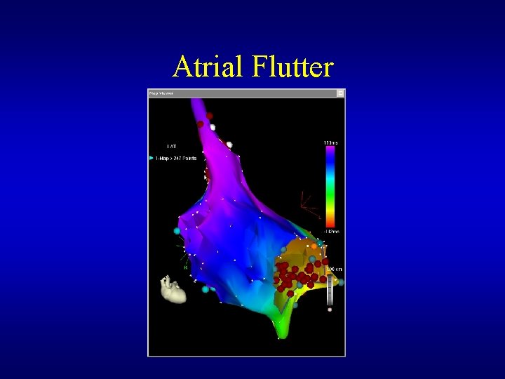 Atrial Flutter Atrial Flutter