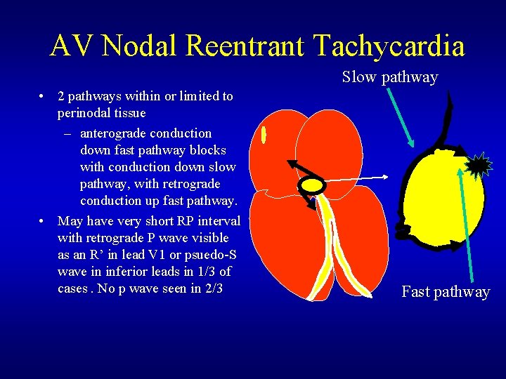 AV Nodal Reentrant Tachycardia Slow pathway • 2 pathways within or limited to perinodal AV Nodal Reentrant Tachycardia Slow pathway • 2 pathways within or limited to perinodal
