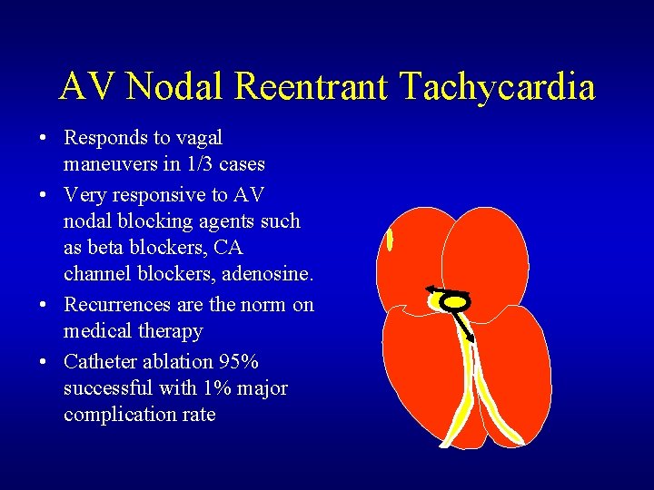 AV Nodal Reentrant Tachycardia • Responds to vagal maneuvers in 1/3 cases • Very AV Nodal Reentrant Tachycardia • Responds to vagal maneuvers in 1/3 cases • Very