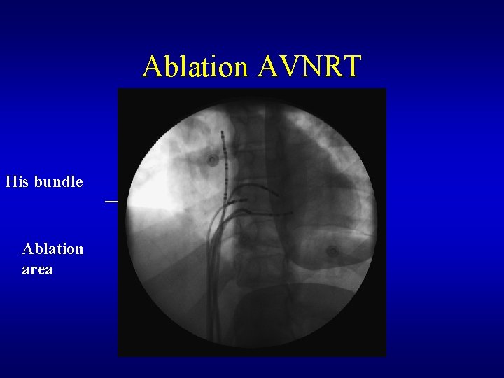 Ablation AVNRT His bundle Ablation area Ablation AVNRT His bundle Ablation area