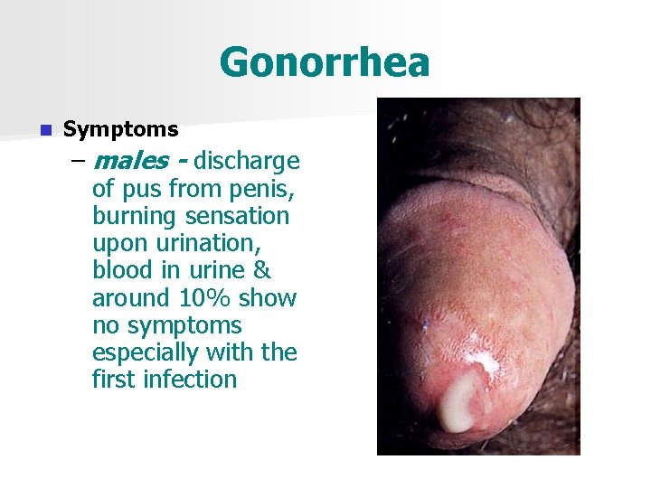 Gonorrhea n Symptoms: – males - discharge of pus from penis, burning sensation upon