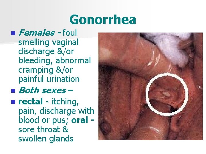 Gonorrhea n Females - foul smelling vaginal discharge &/or bleeding, abnormal cramping &/or painful