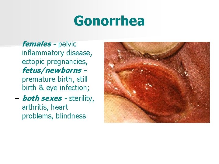 Gonorrhea – females - pelvic inflammatory disease, ectopic pregnancies, fetus/newborns premature birth, still birth