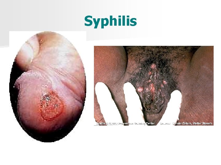 Syphilis 