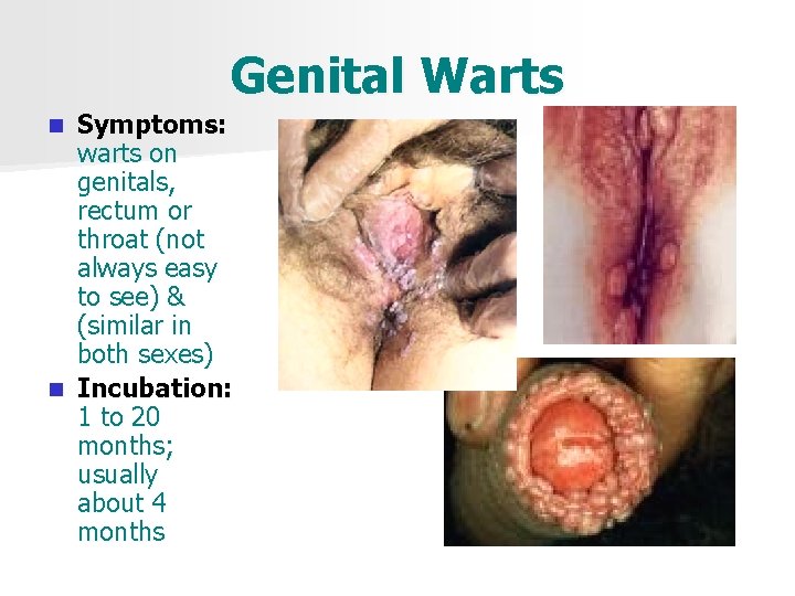 Genital Warts Symptoms: warts on genitals, rectum or throat (not always easy to see)