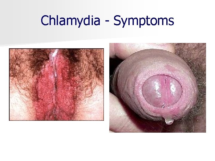 Chlamydia - Symptoms 