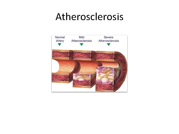 Atherosclerosis 