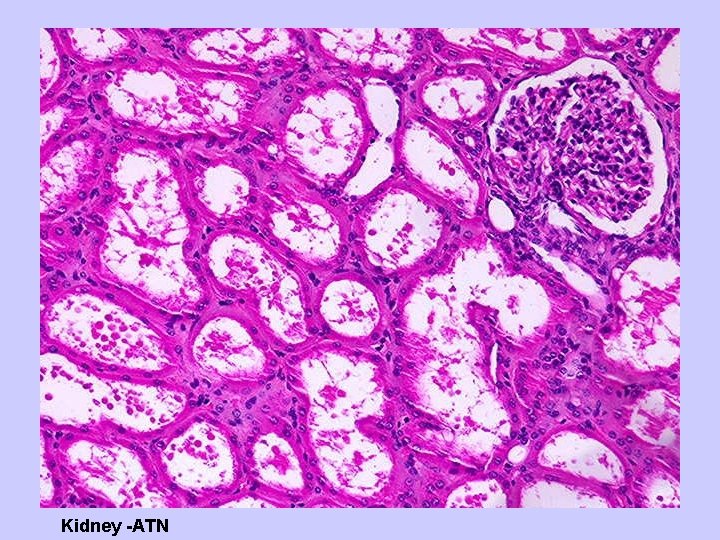 Kidney -ATN 