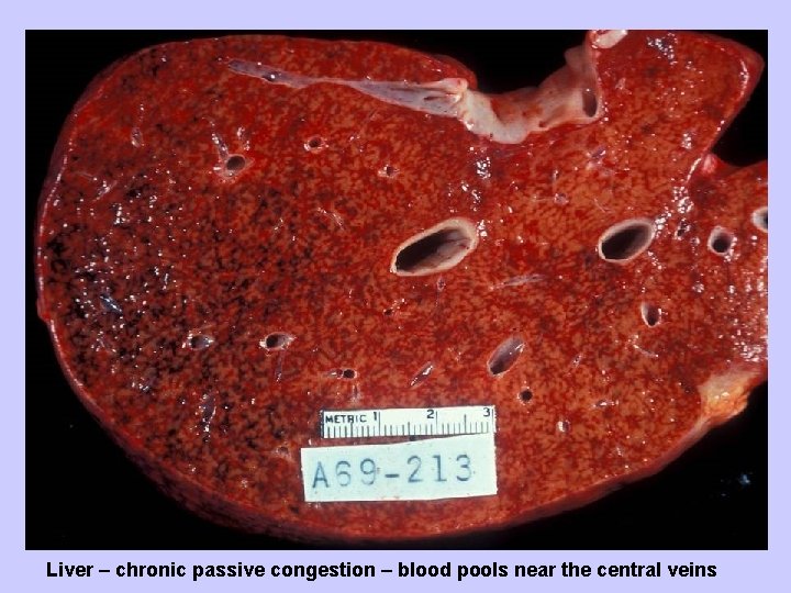 Liver – chronic passive congestion – blood pools near the central veins 