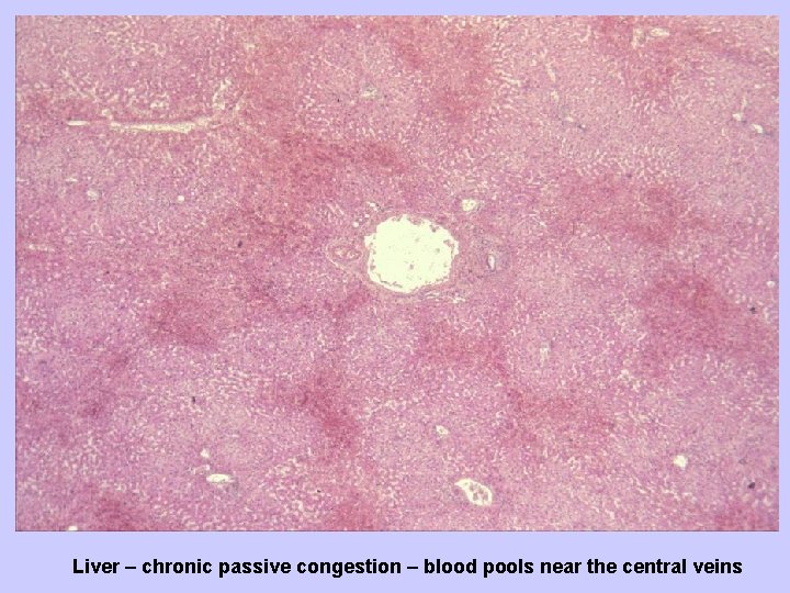 Liver – chronic passive congestion – blood pools near the central veins 