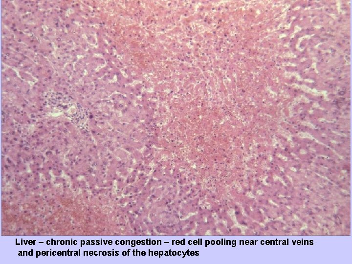 Liver – chronic passive congestion – red cell pooling near central veins and pericentral