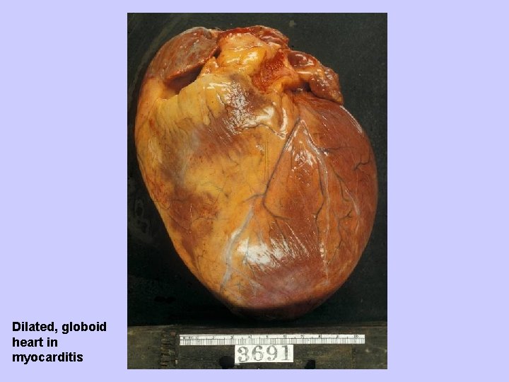 Dilated, globoid heart in myocarditis 