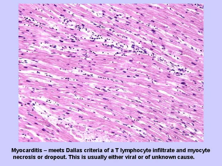 Myocarditis – meets Dallas criteria of a T lymphocyte infiltrate and myocyte necrosis or