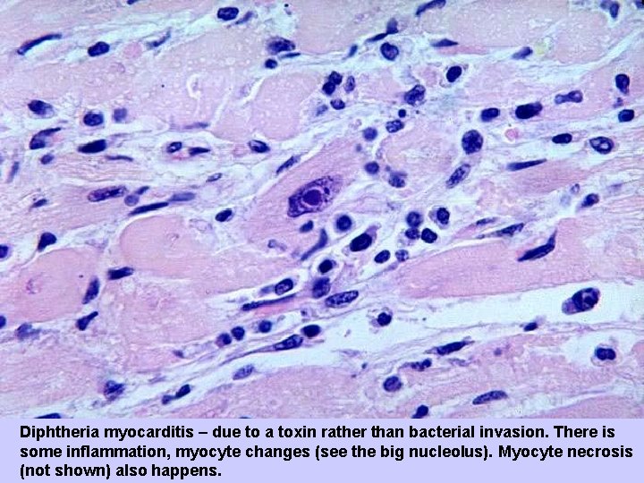 Diphtheria myocarditis – due to a toxin rather than bacterial invasion. There is some