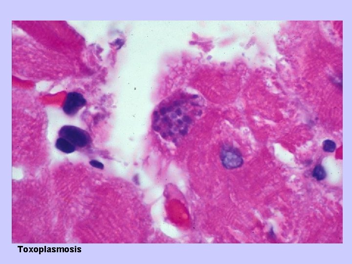 Toxoplasmosis 