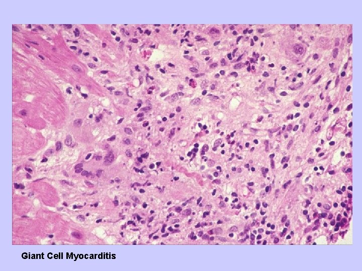 Giant Cell Myocarditis 