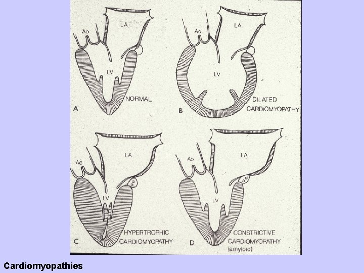 Cardiomyopathies 