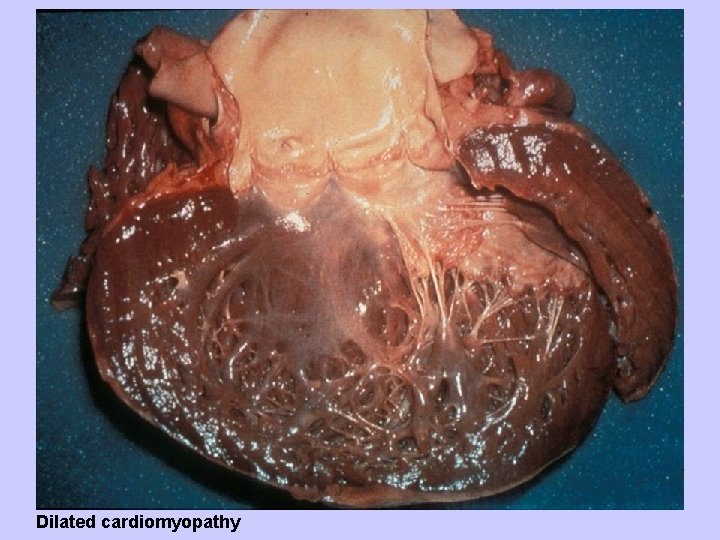 Dilated cardiomyopathy 