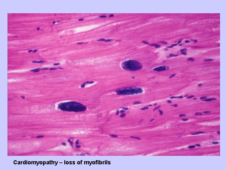 Cardiomyopathy – loss of myofibrils 