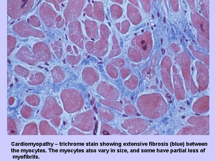 Cardiomyopathy – trichrome stain showing extensive fibrosis (blue) between the myocytes. The myocytes also