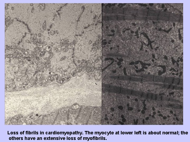 Loss of fibrils in cardiomyopathy. The myocyte at lower left is about normal; the