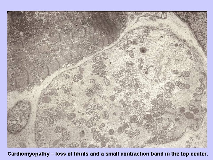 Cardiomyopathy – loss of fibrils and a small contraction band in the top center.