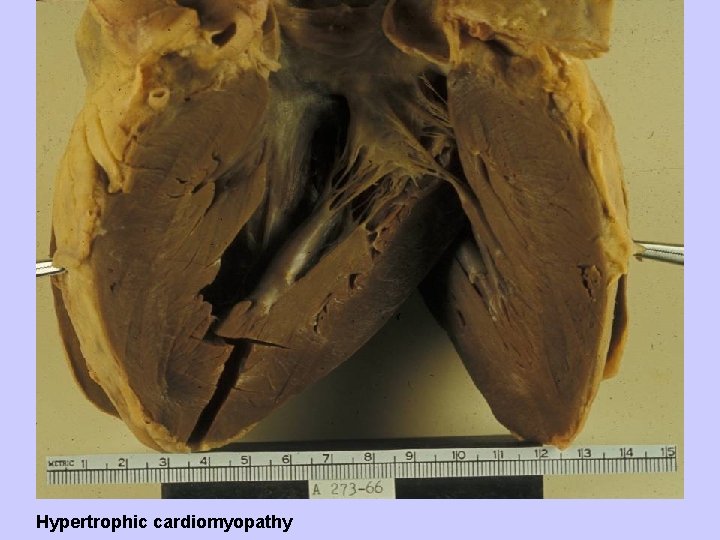 Hypertrophic cardiomyopathy 