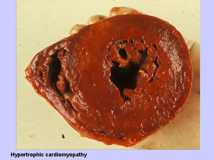 Hypertrophic cardiomyopathy 