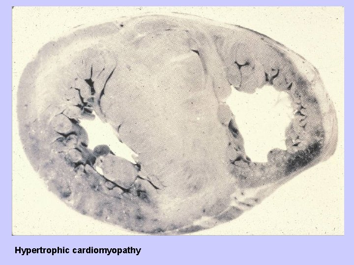 Hypertrophic cardiomyopathy 