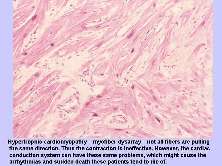 Hypertrophic cardiomyopathy – myofiber dysarray – not all fibers are pulling the same direction.