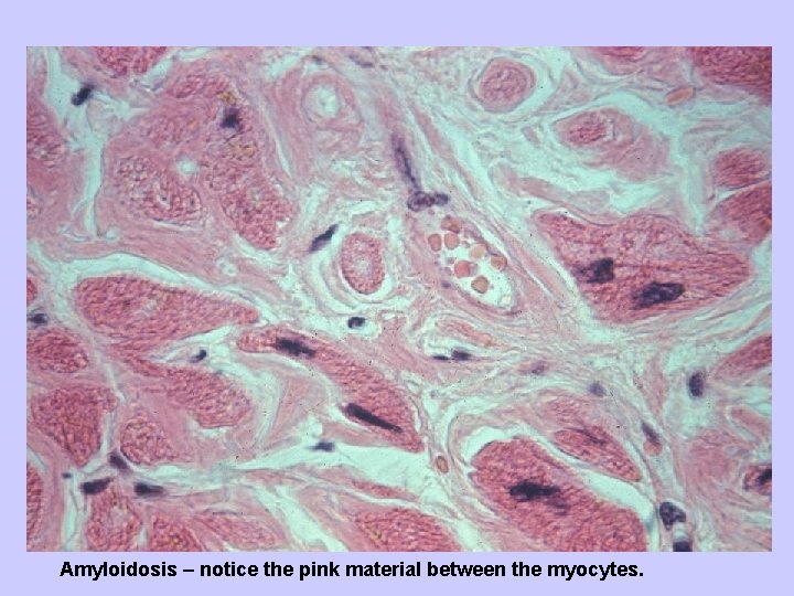 Amyloidosis – notice the pink material between the myocytes. 