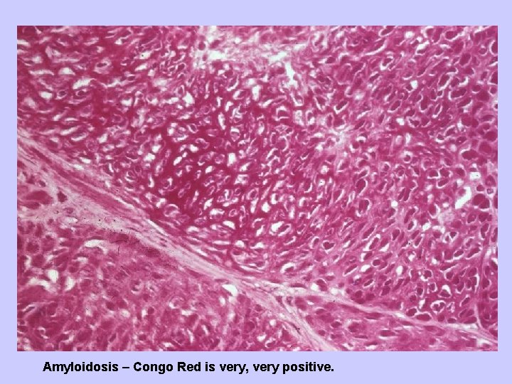 Amyloidosis – Congo Red is very, very positive. 