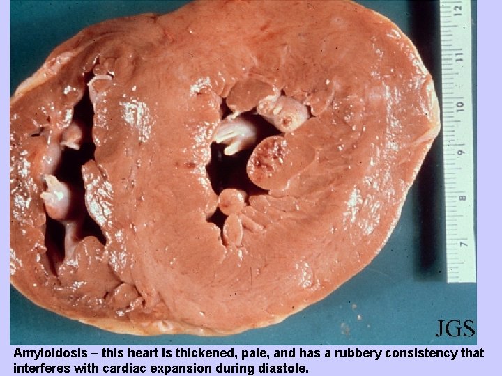 Amyloidosis – this heart is thickened, pale, and has a rubbery consistency that interferes