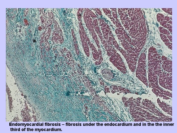 Endomyocardial fibrosis – fibrosis under the endocardium and in the inner third of the