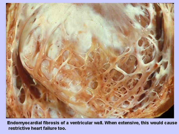 Endomyocardial fibrosis of a ventricular wall. When extensive, this would cause restrictive heart failure