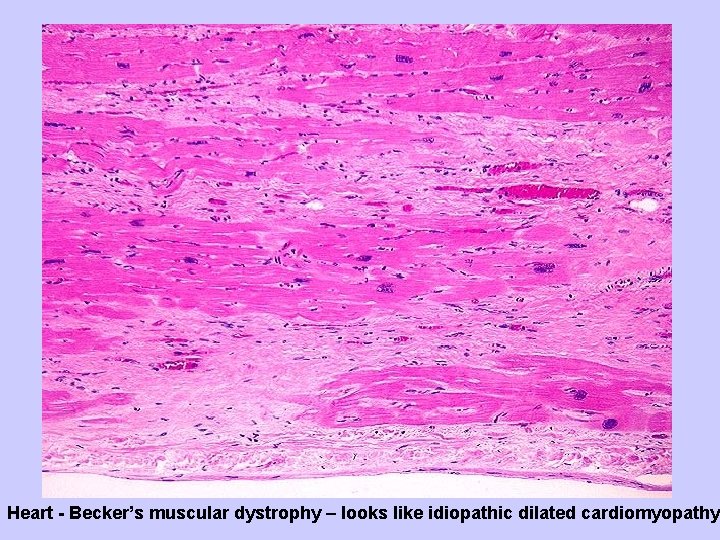 Heart - Becker’s muscular dystrophy – looks like idiopathic dilated cardiomyopathy 
