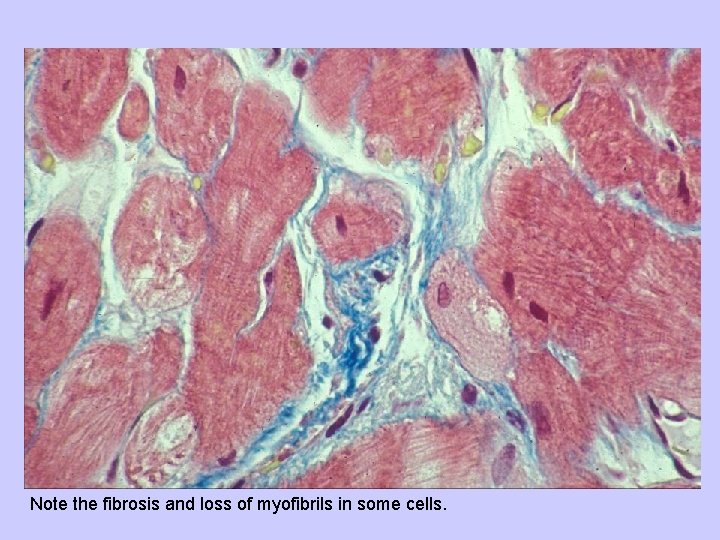 Note the fibrosis and loss of myofibrils in some cells. 