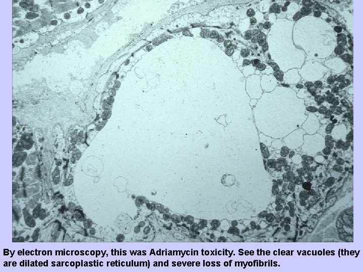 By electron microscopy, this was Adriamycin toxicity. See the clear vacuoles (they are dilated