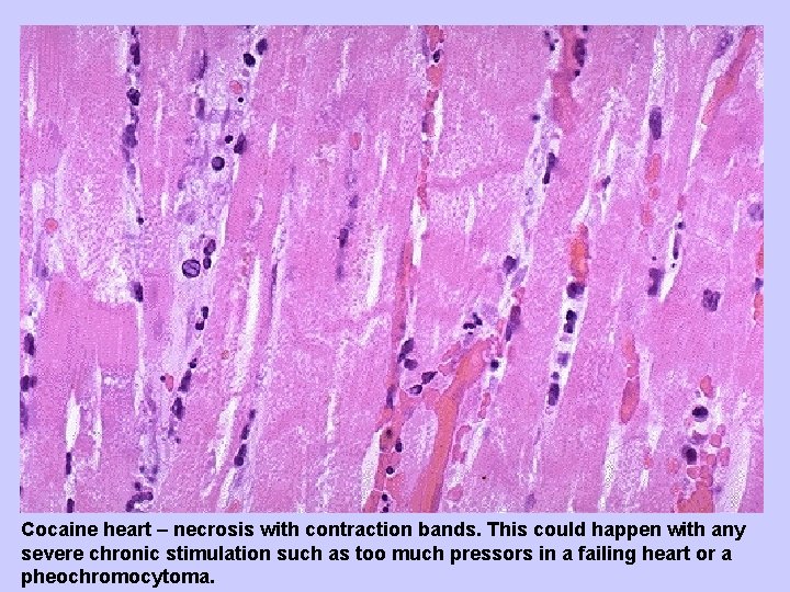 Cocaine heart – necrosis with contraction bands. This could happen with any severe chronic