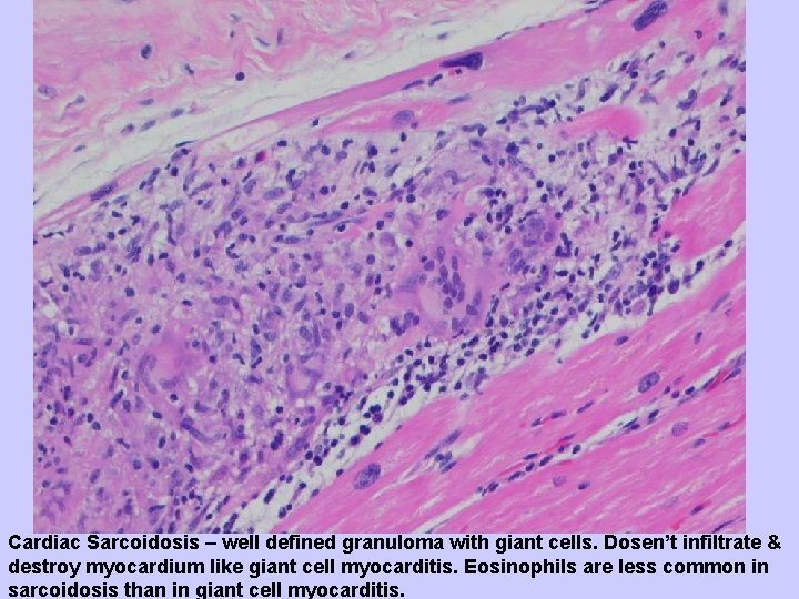 Cardiac Sarcoidosis – well defined granuloma with giant cells. Dosen’t infiltrate & destroy myocardium