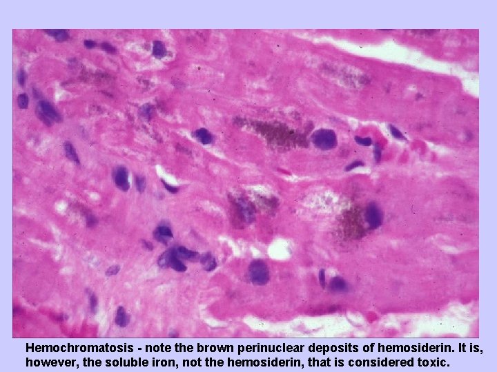 Hemochromatosis - note the brown perinuclear deposits of hemosiderin. It is, however, the soluble