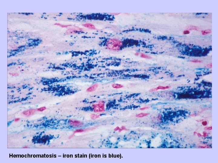 Hemochromatosis – iron stain (iron is blue). 