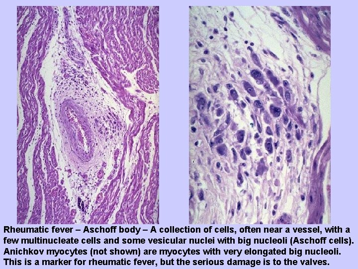 Rheumatic fever – Aschoff body – A collection of cells, often near a vessel,