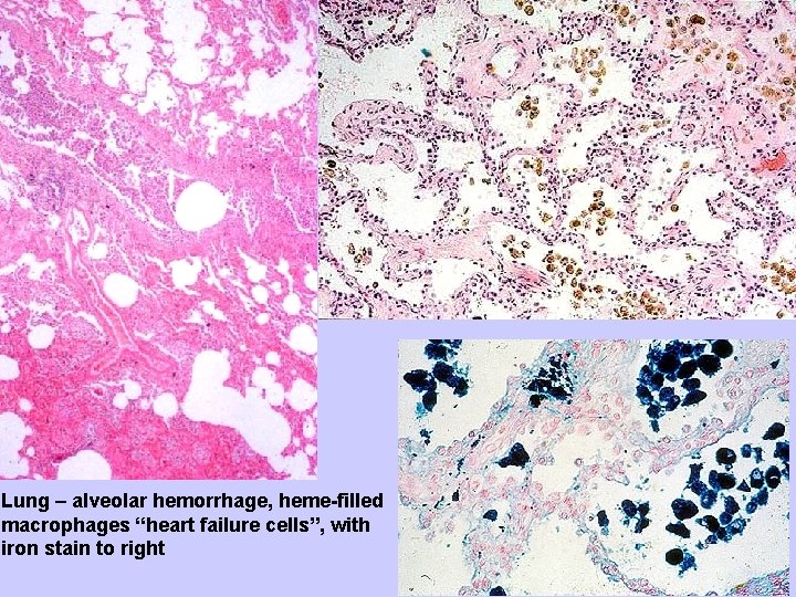 Lung – alveolar hemorrhage, heme-filled macrophages “heart failure cells”, with iron stain to right