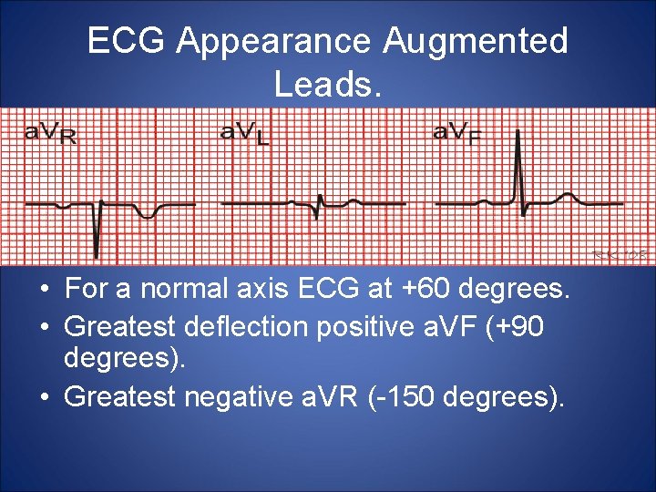 ECG Appearance Augmented Leads. • For a normal axis ECG at +60 degrees. •