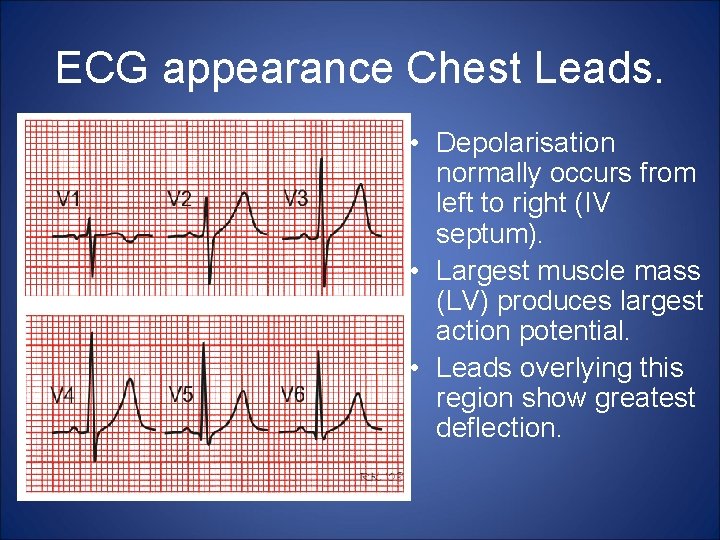 ECG appearance Chest Leads. • Depolarisation normally occurs from left to right (IV septum).