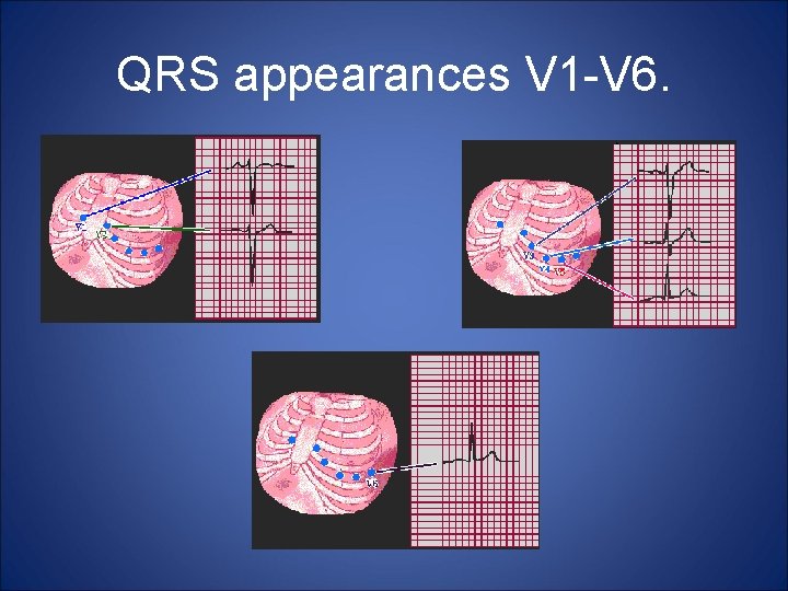 QRS appearances V 1 -V 6. 